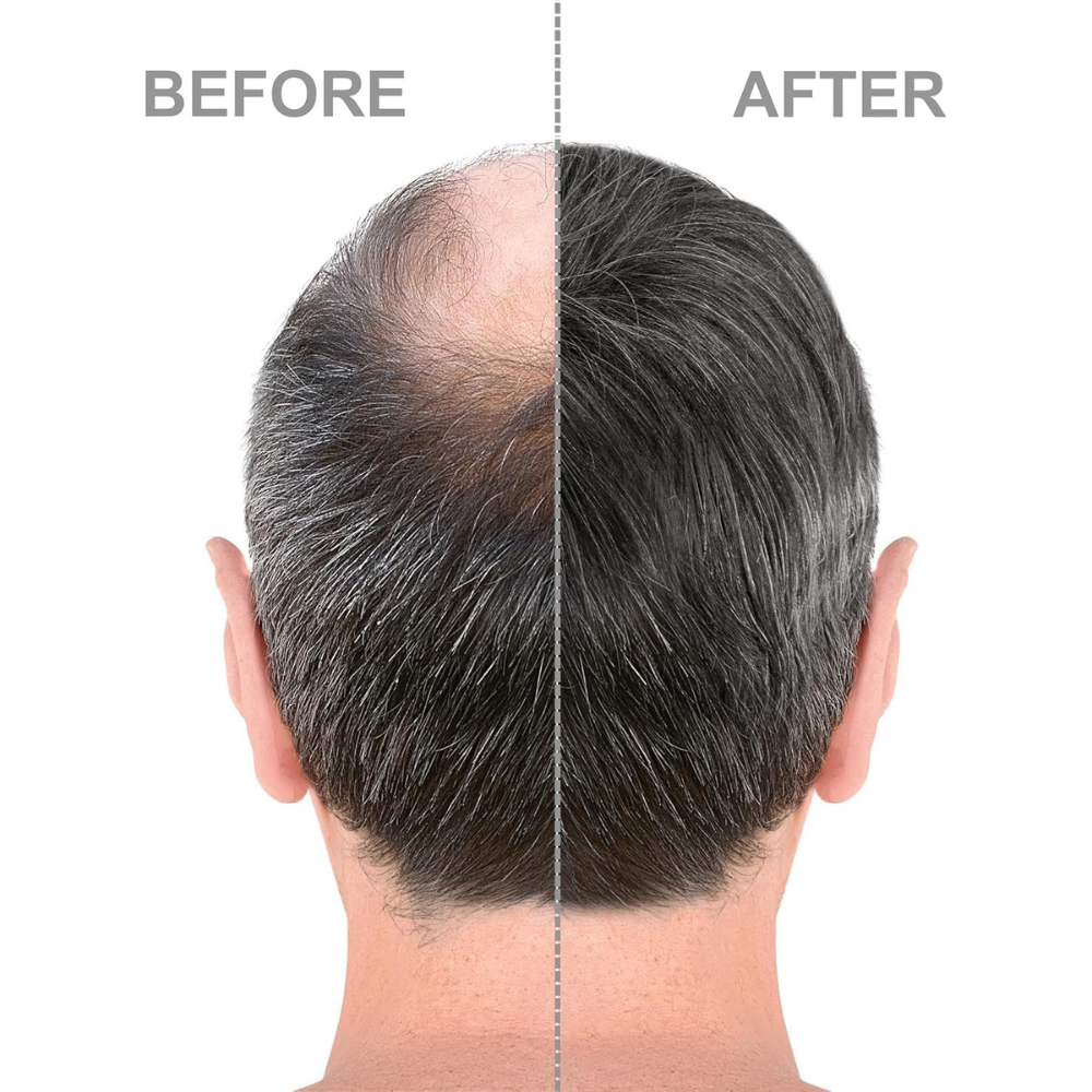 Minoxidil 5% Extra Forte para Homens - Miniatura 2