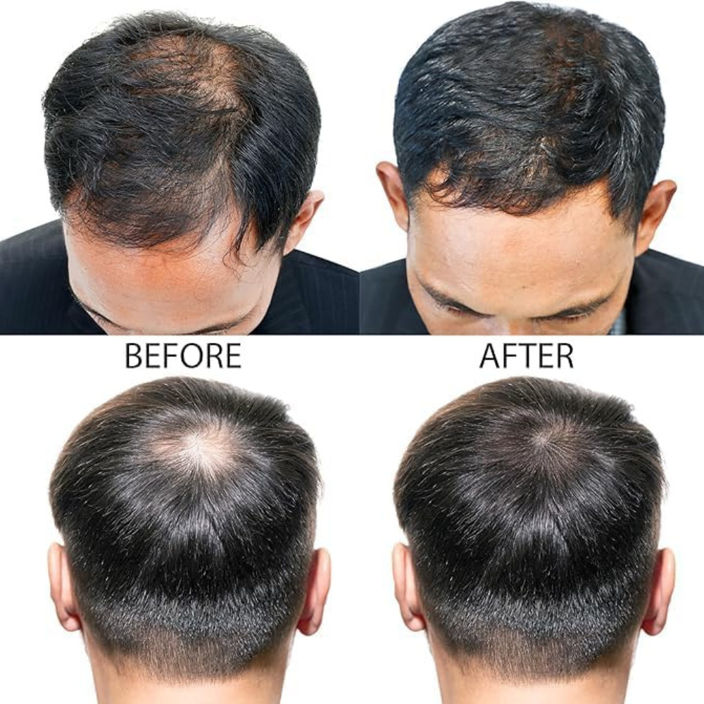 Minoxidil 5% Extra Forte para Homens - Miniatura 6